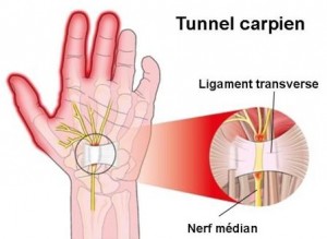 Clinique-chiropratique-Chambly-invertrac-traitement-tunnel-carpien